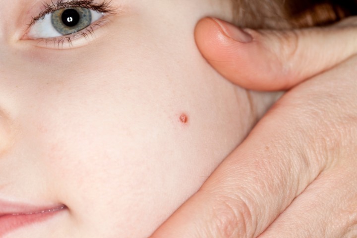 Close-up of a child's face with a visible wart being examined