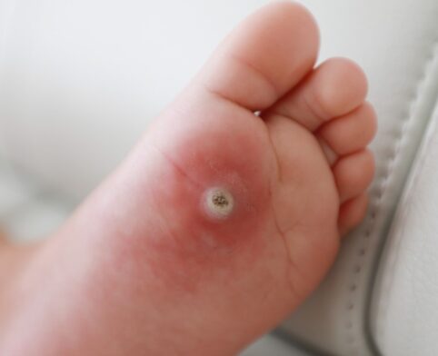 Close-up of a wart on a child's foot before cryotherapy treatment