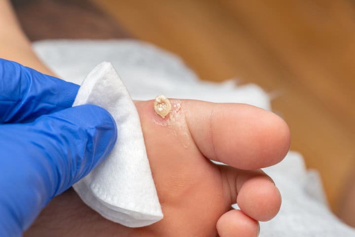 Cleaning a child’s foot after cryotherapy wart removal