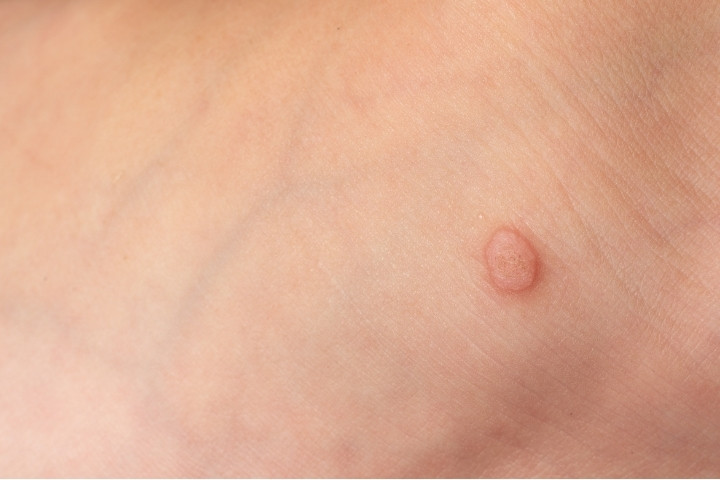 Raised wart on a child’s skin, what to look for when doing an at home check