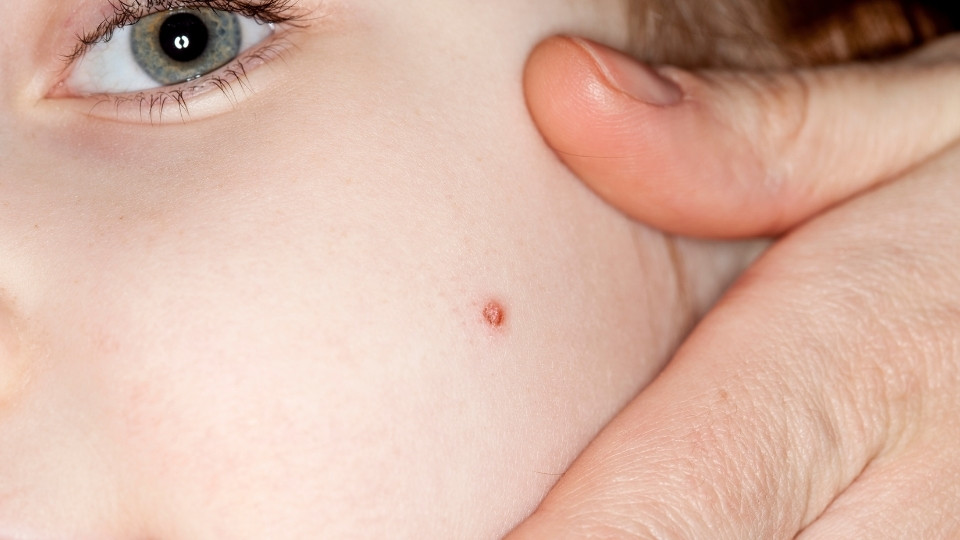 Facial wart on a child’s cheek