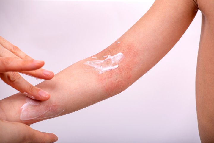 Child with red irritated skin receiving cream for an allergy related eczema flare