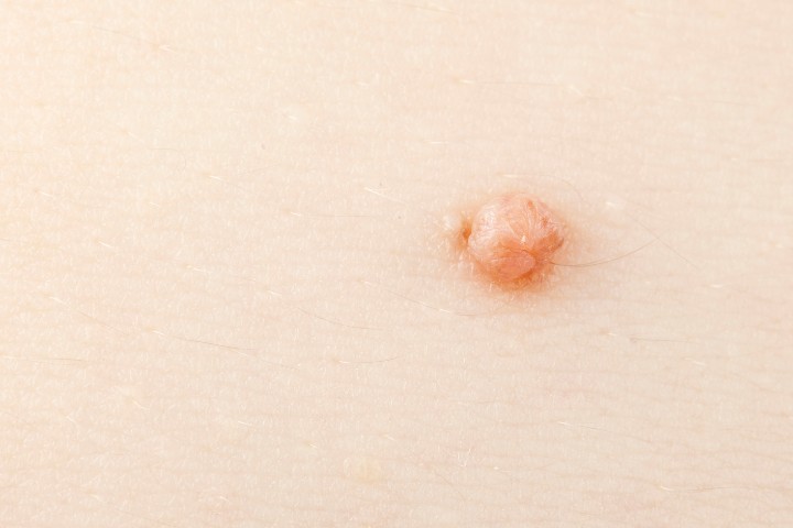 Close up of a common skin wart