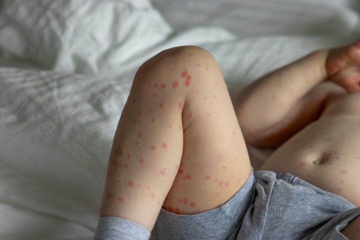 Roseola rash on child’s legs